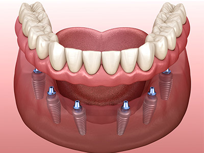 All-On-6 Dental Implants in Citrus Park