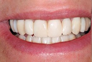 COPT Dental Design | Teeth Whitening, Extractions and Night Guards